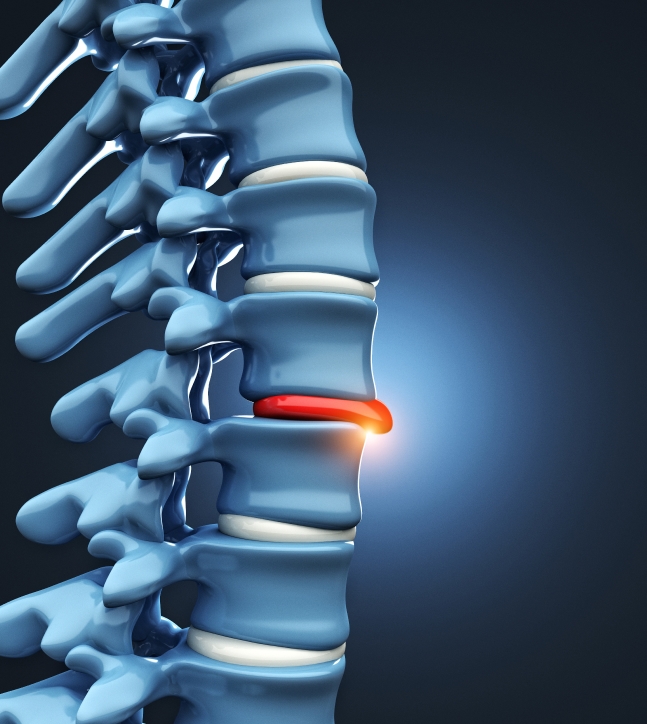 Herniated Disc Treatment in Saratoga, Glens Falls & Malta